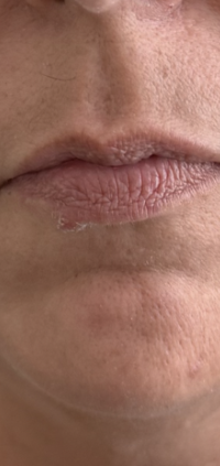 Before treatment