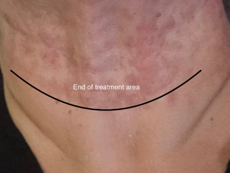 Pico Resolve Facial, 1st Treatment - Before