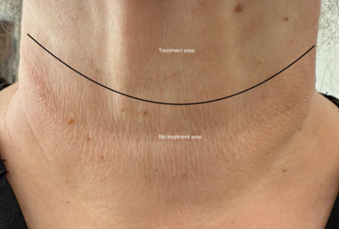 Pico Resolve Facial, 1st Treatment - After