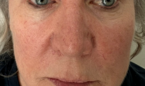 Pico Resolve Facial, 1st Treatment - Before