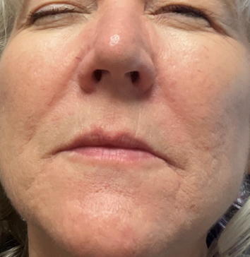 Pico Resolve Facial, 1st Treatment - After