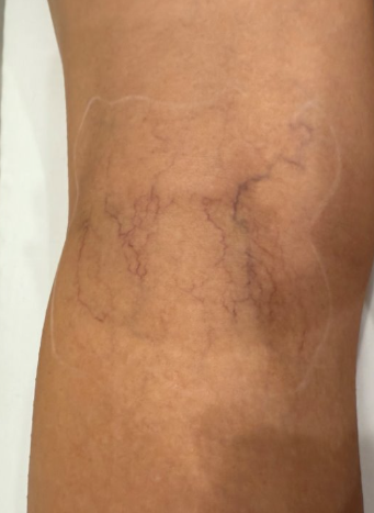 Before treatment