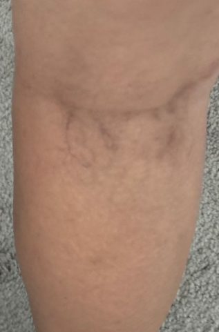 After treatment