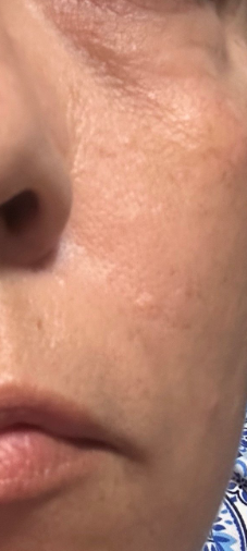 After treatment