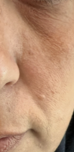 Before treatment
