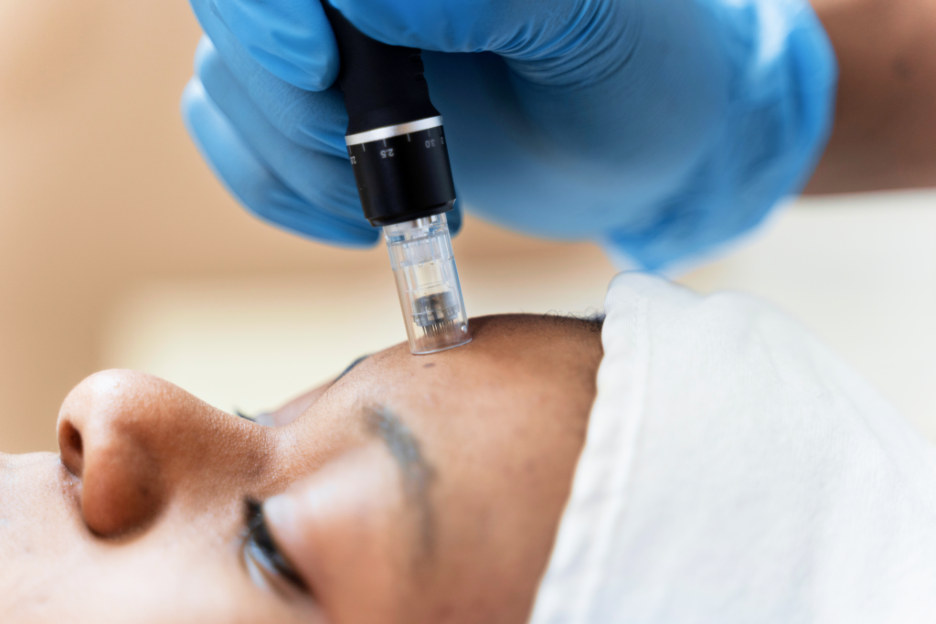 Microneedling