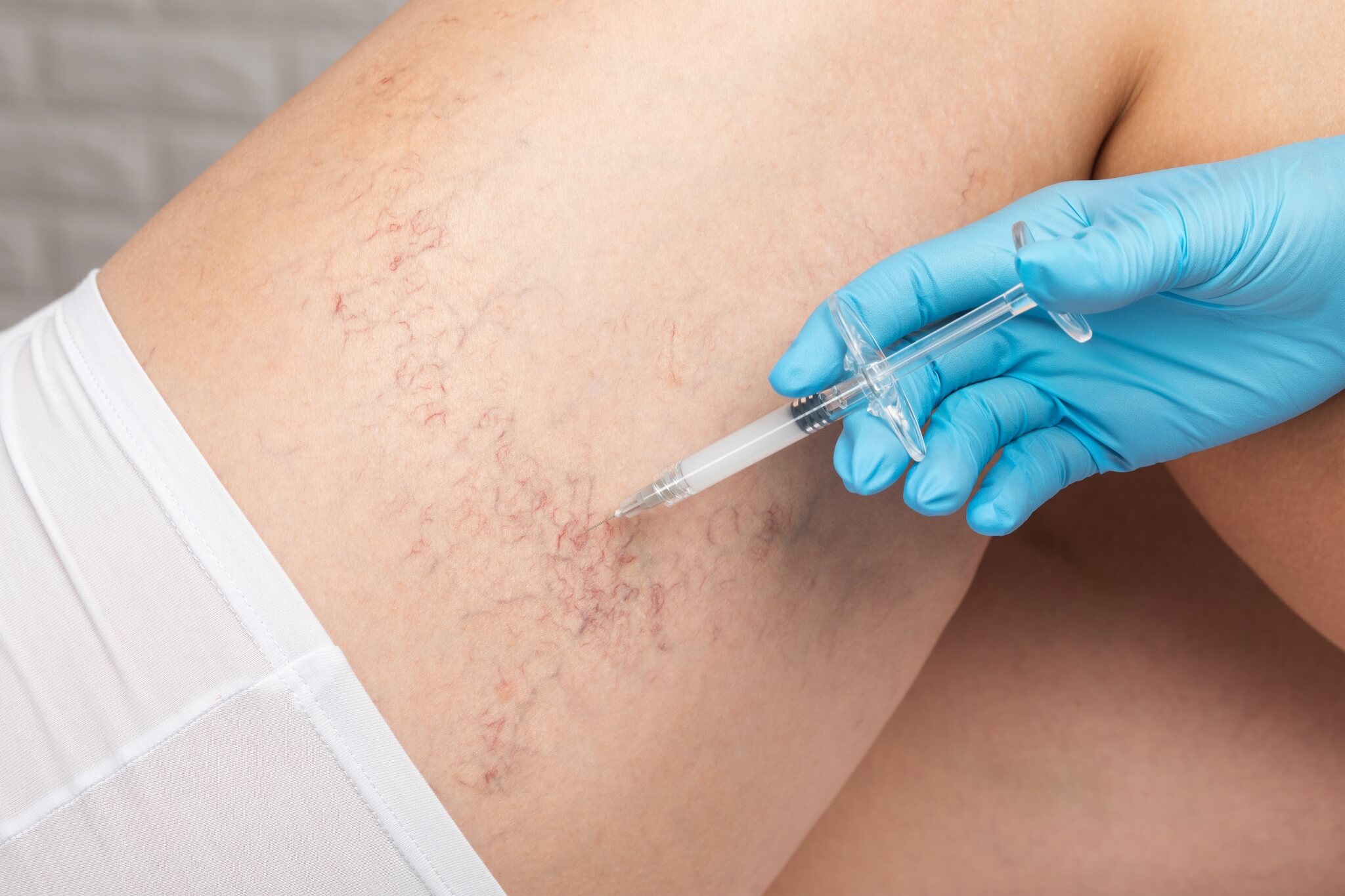 Sclerotherapy