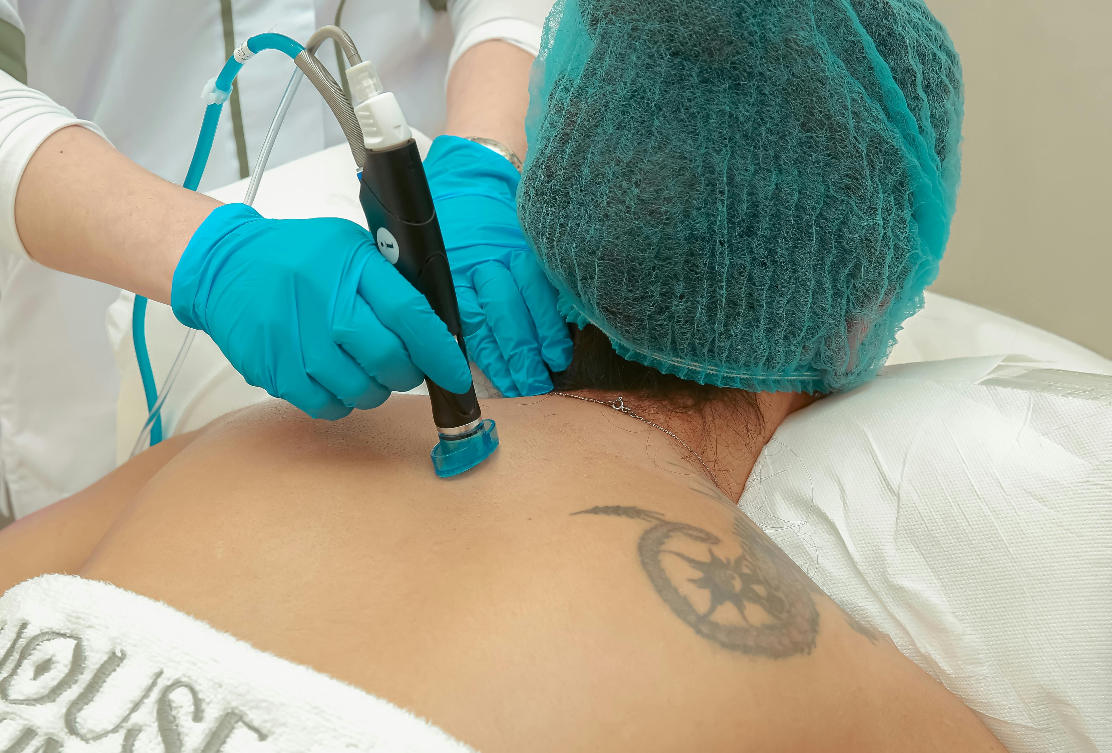 Laser Tattoo Removal